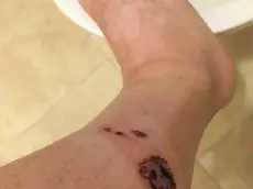 Il polpaccio del turista un giorno dopo il morso del cane