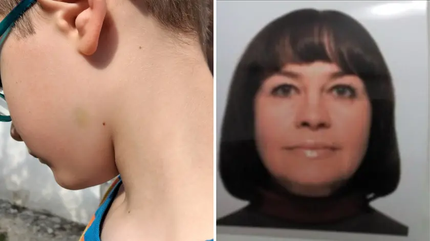 A sinistra il livido sul collo del figlio nell'aggressione di giugno del 2023, a destra Olena Stasiuk