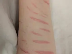 La storia di Paola, che per 4 anni si è tagliata braccia e gambe