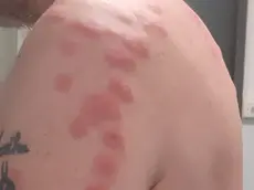 Lo sfogo sulla pelle del cliente dovuto alle cimici