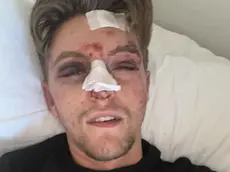 Daniel Fontana, cuoco bellunese aggredito a Jesolo